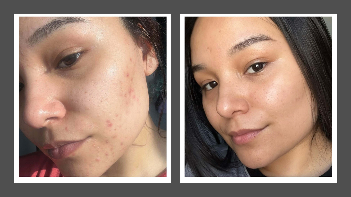 WOOSHIE'S BLEND - EXTRAORDINARY FACE OIL for OILY/PROBLEMATIC SKIN